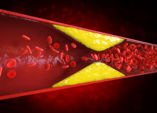 riesgo cardiovascular y cómo bajar el colesterol naturalmente