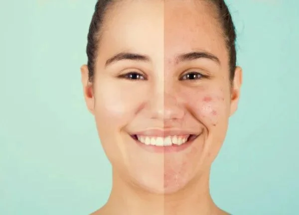 cómo eliminar el acné de forma natural